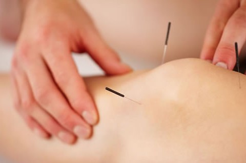 Introducing Acupuncture!!